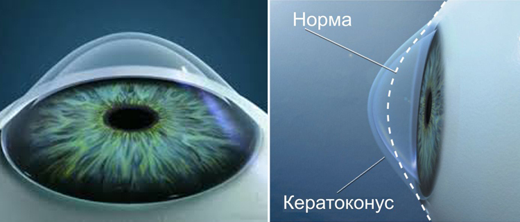 Кератоконус - сравнение с нормальным глазом